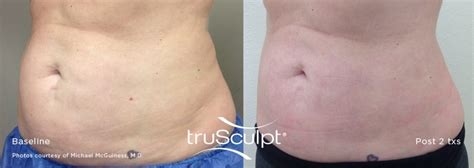 Trusculpt 3d Body Contouring Downey Varicose Vein Laser Center