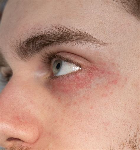 Skin Concern At A Loss Trying To Deal With This Rash Around My Eyes Probably Dermatitis Or