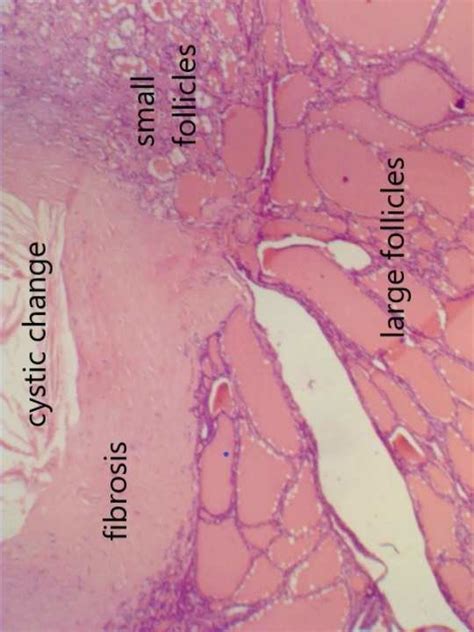 Multinodular Goiter Histology