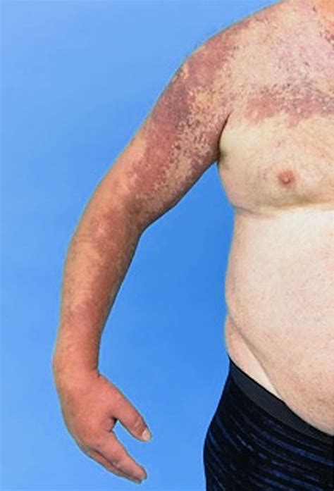 Compva Klippel Trénaunay Syndrome