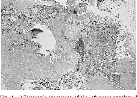 Figure From Double Parathyroid Carcinoma Semantic Scholar