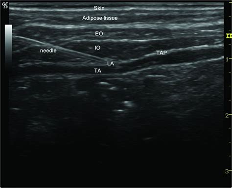 Ultrasound Guided Transversus Abdominis Plane Block Anesthesia Key