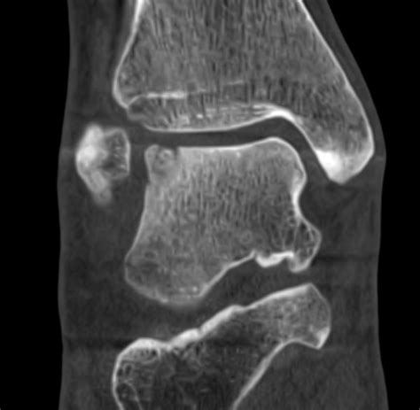 Osteochondrale L Sion Des Talus Ortho Pede Zentrum F R Fu Und