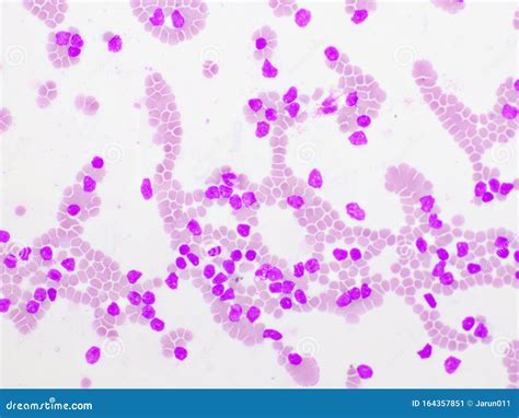 Picture Of Acute Lymphocytic Leukemia Or All Cells In Blood Smear Stock