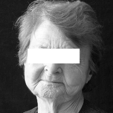 Teleangectasias are visible on the face of the patient. | Download ...