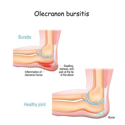 Bursitis de Olecranon codo de estudiante condición médica