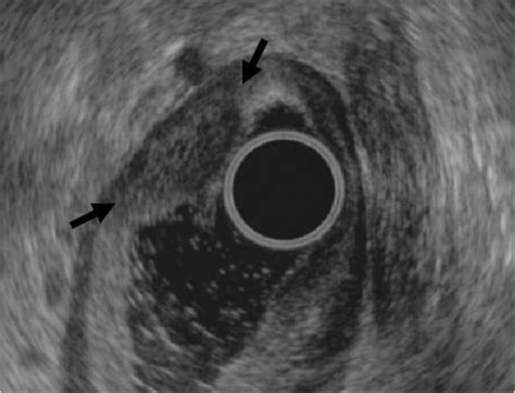 Endoscopic Ultrasonography Showing A Hypoechoic Mass Without Clear Download Scientific Diagram