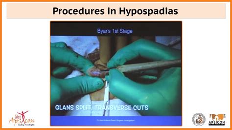 Procedures In Hypospadias Youtube