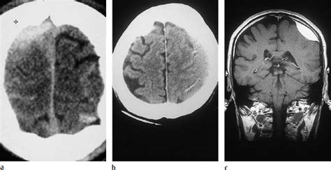 Craniocerebral Trauma Radiology Key