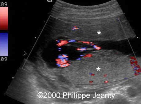 📃 Succenturiate & bilobate placenta