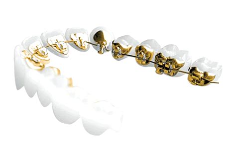 Incognito™ Lingual Braces London | Origin Orthodontics