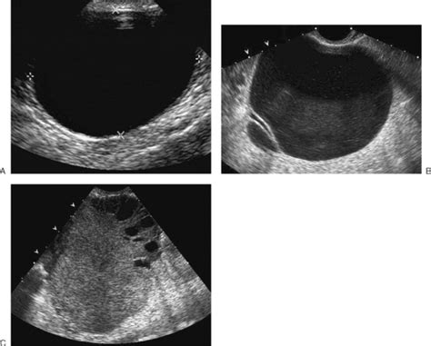 Ultrasound Evaluation Of The Adnexa Ovary And Fallopian Tubes Radiology Key