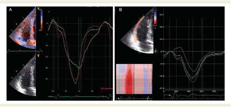 Table 2 From The Echocardiographic Assessment Of The Right Ventricle