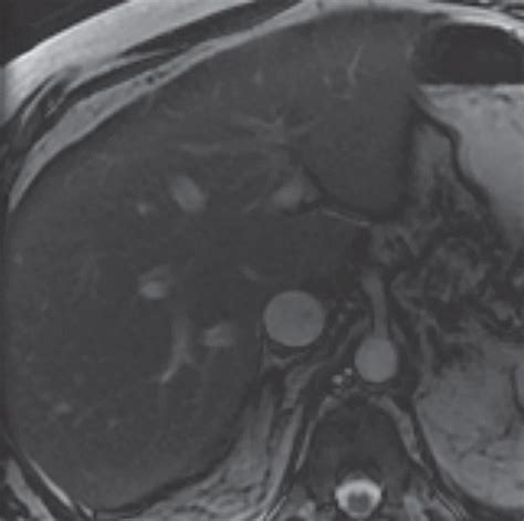 Imaging Findings Of Congestive Hepatopathy Radiographics