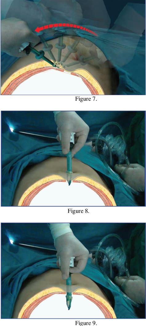 Pdf The Safety And Complications Of Z Entry Technique Of Trocar