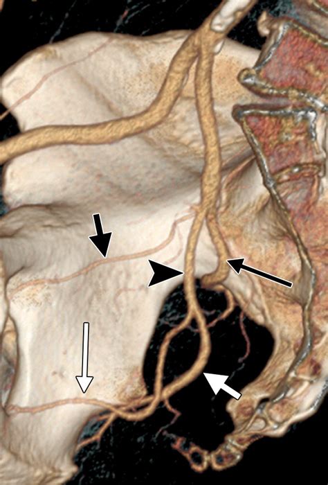 Obturator Artery Angiogram