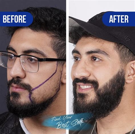 Beard Transplant Before And After Vera Clinic