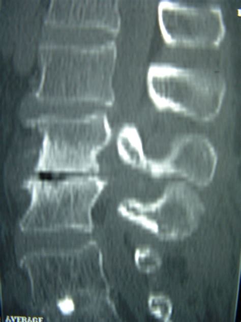 Extreme Lateral Interbody Fusion Xlif Back In Control