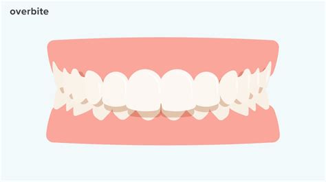 Overbite Braces: Best Options, Alternative Treatments