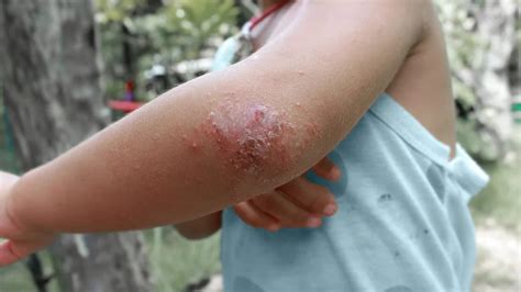 Eczema Bumps On Elbows