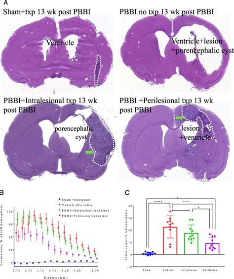 Human Neural Stem Cell Transplants Mitigate PTBI Lesion Representative