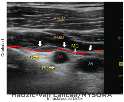 Ultrasound Guided Infraclavicular Brachial Plexus Block Nysora The