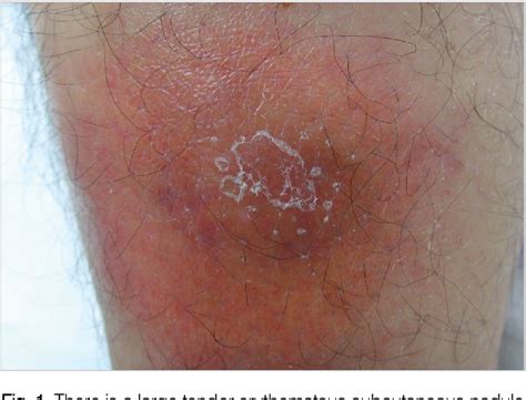 Figure From A Case Of Pancreatitis Presenting With Pancreatic