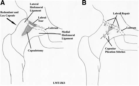 Differential Diagnosis Of Pain Around The Hip Joint Arthroscopy