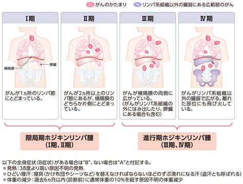 どんな検査をするの？診断の流れ、病期分類など ホジキンリンパ腫 Msd Oncology がんを生きる