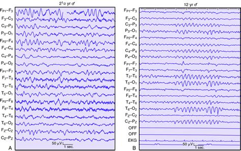 EEG demonstrating frontal and occipital rhythmic activity. A, EEG of a ...