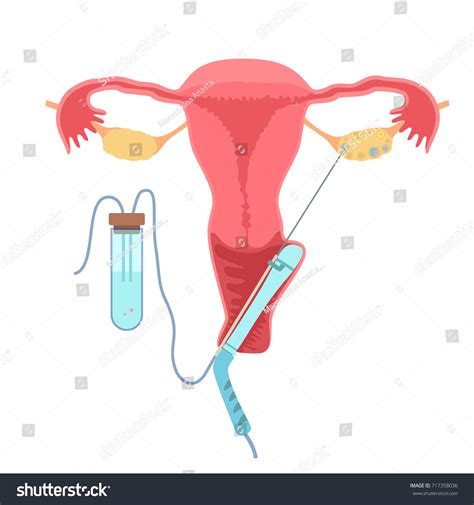 Vitro Fertilization Method Embryo Transfer Stock Vector Royalty Free