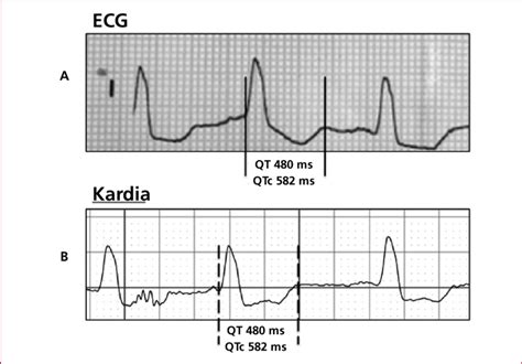 A Measurement Of Prolonged Qtc Interval In Lead I In A Surface Ecg