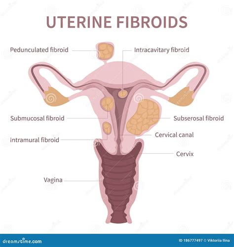 Diagrama De Fibromas Uterinos Femeninas Sobre Fondo Blanco Ilustración Del Vector Ilustración