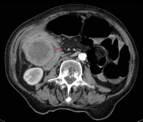 Gallbladder Perforation Radiological Aspects Types And Causes