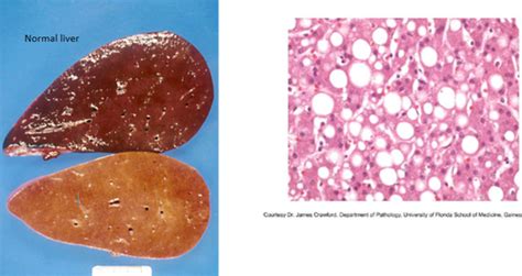 Clin Path Ii Liver Part I Flashcards Quizlet