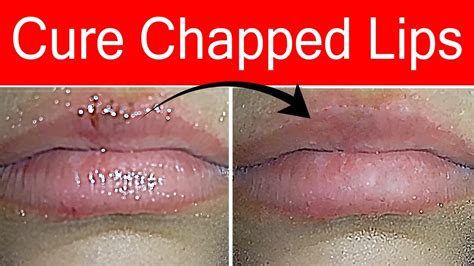 How To Cure Chapped Lips That Won T Go Away At Earnest Davis Blog