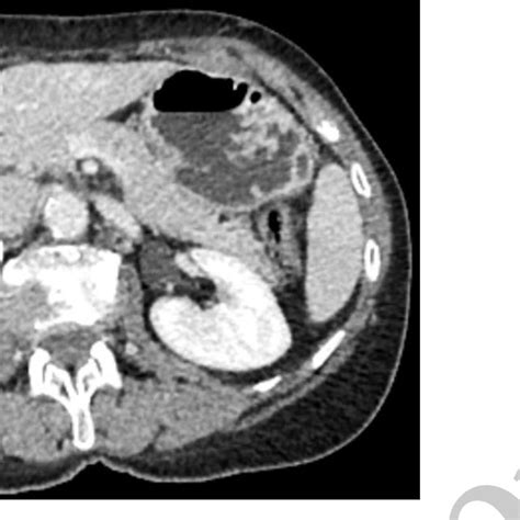 Abdominal Ct Scan Showing A Hydatid Cyst In Segment Vi Of The Liver Download Scientific Diagram