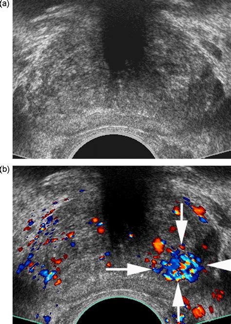 Contrast Enhanced Ultrasound For Diagnosis Of Prostate Cancer And