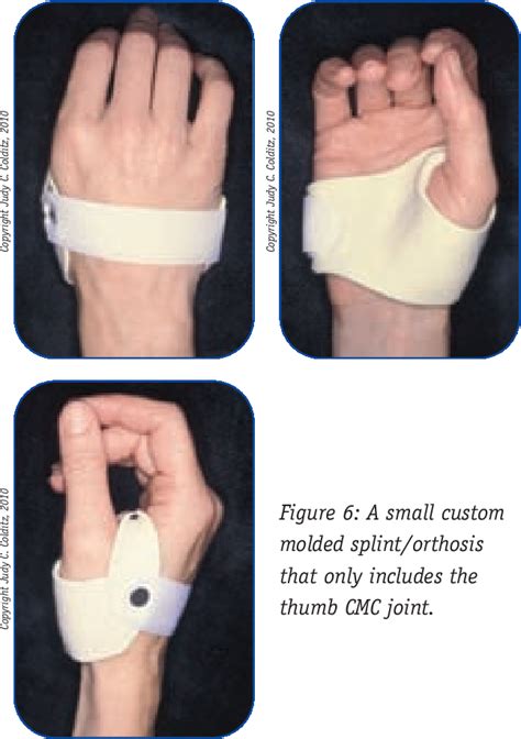 A New Splint Design for the Thumb CMC Joint | Semantic Scholar