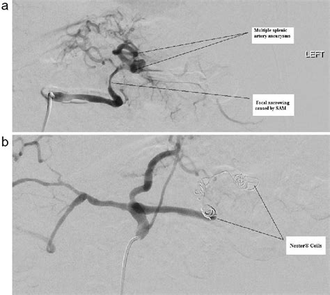 A Digital Subtraction Angiography Dsa Showing Splenic Artery