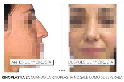 Rinoplastia Secundaria Recupera Tu Nariz Dra Mart Nez Padilla