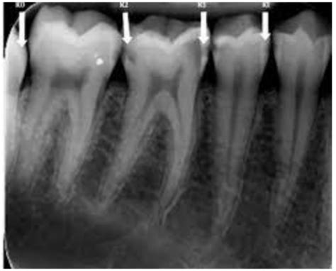 Chapter 33 Interpretation Of Caries Flashcards Quizlet