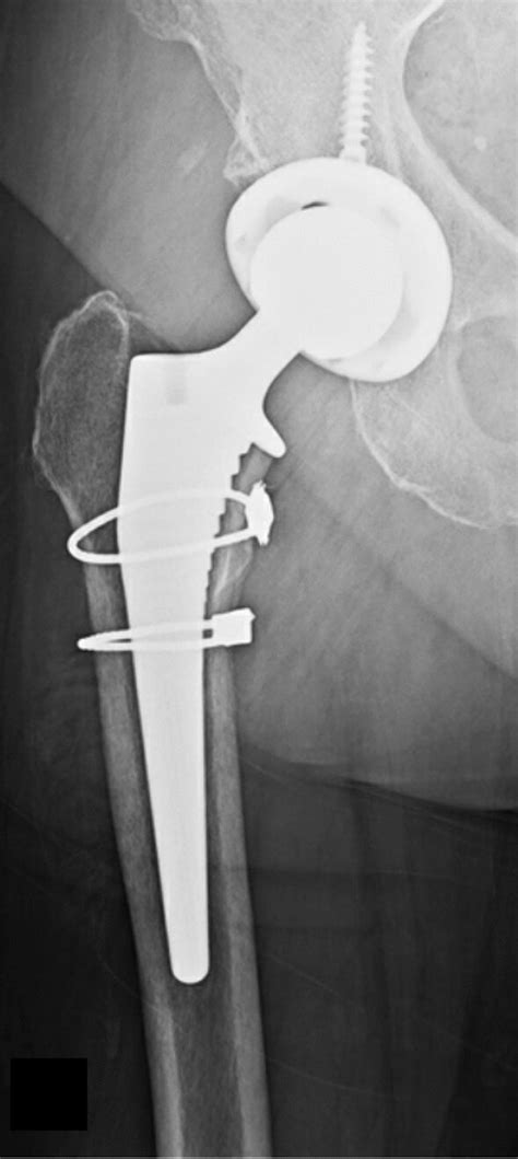 Anteroposterior Radiographs Six Week Post Total Hip Arthroplasty With Download Scientific