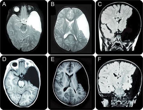 arachnoid cyst mri radiology