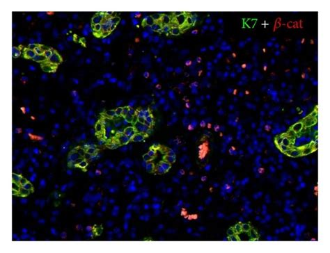 Partial Expression Of Some Mesenchymal Features By Ductular Reactive