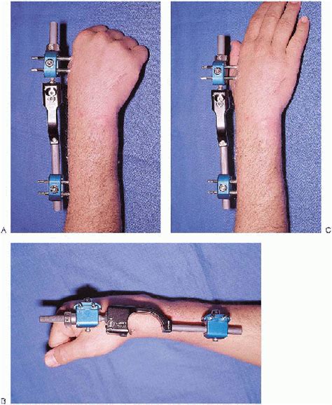 Subtrochanteric Fractures Teachme Orthopedics