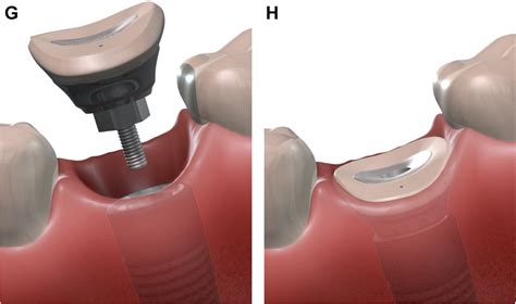 Clinical Advantages Of Immediate Posterior Implants With Custom Healing