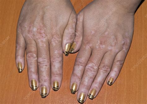Vitiligo Of The Hands Stock Image C0018636 Science Photo Library