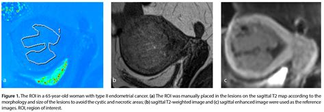 Role Of T2 Mapping Of Magnetic Resonance Imaging In The Differentiation Of Endometrial Cancer