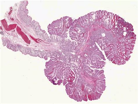 Pathology Neoplasm Ppt